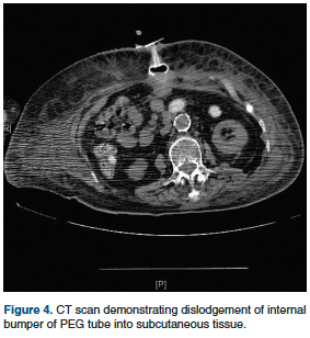Complications Associated with Percutaneous Endoscopic Gastrostomy Tubes